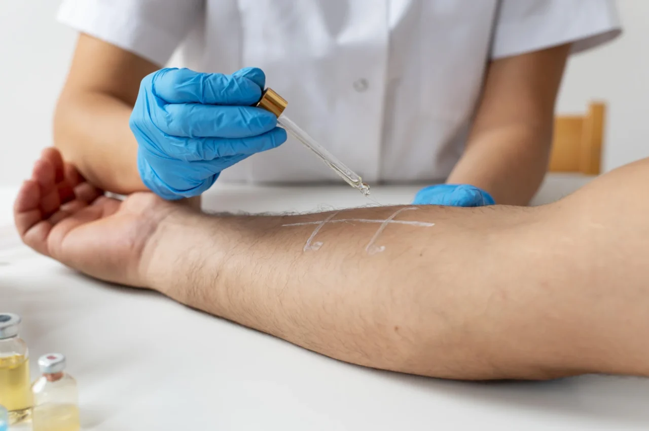 Aplicação de teste alérgico na pele do antebraço
